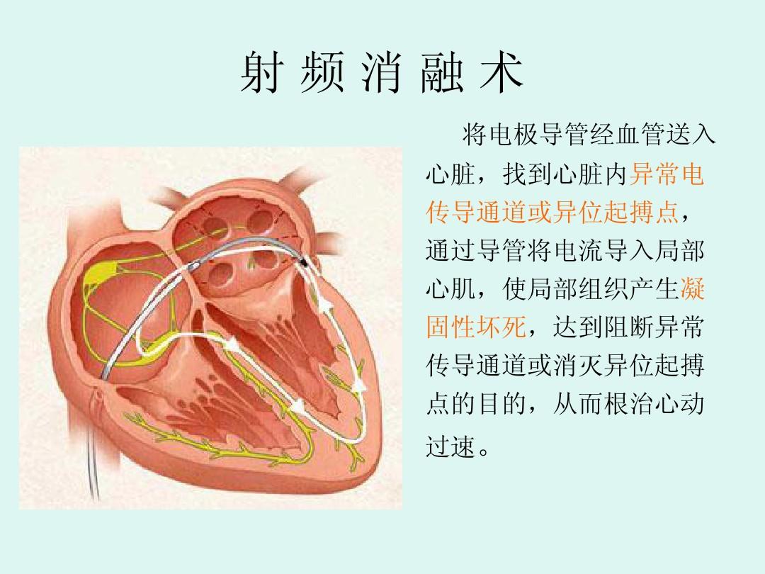 射频消融术3.jpg