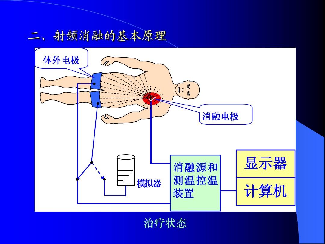 射频消融术2.jpg