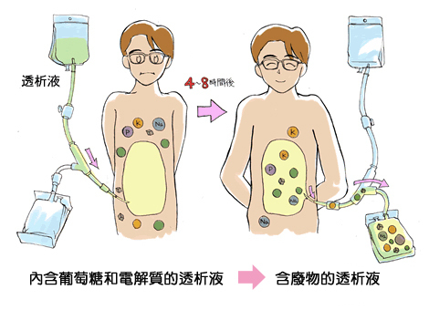 腹膜透析5.png