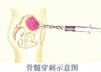 骨髓穿刺3.jpeg