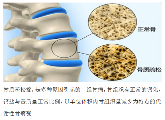 HL0801骨质疏松骨质疏松.png