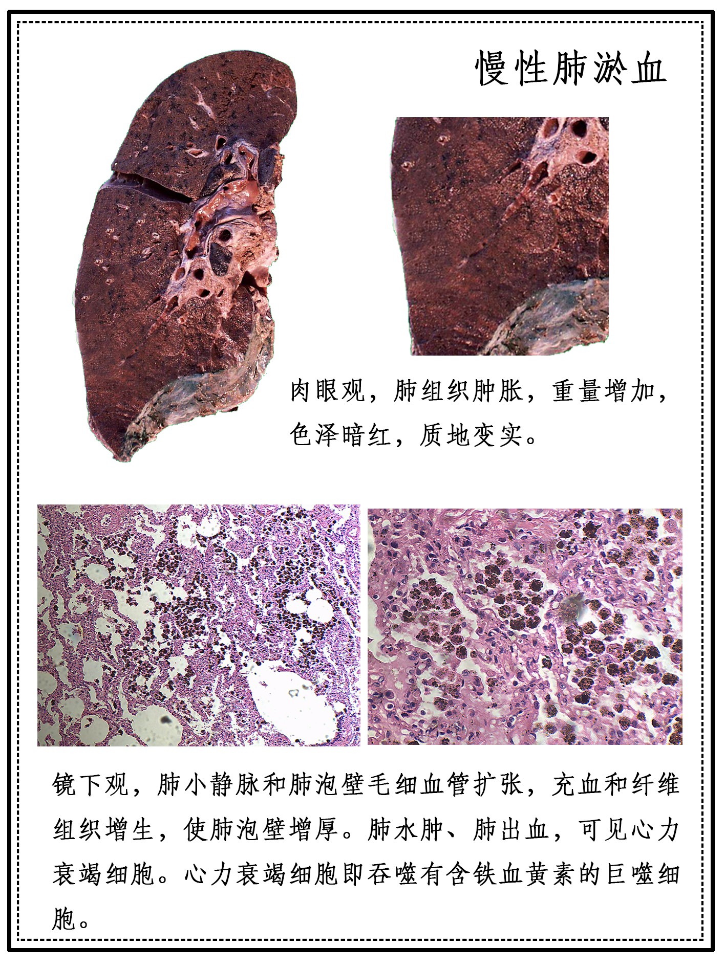 慢性肺淤血