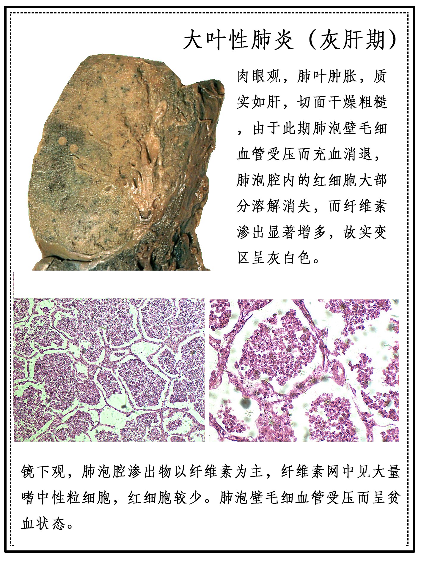 大叶性肺炎灰肝期
