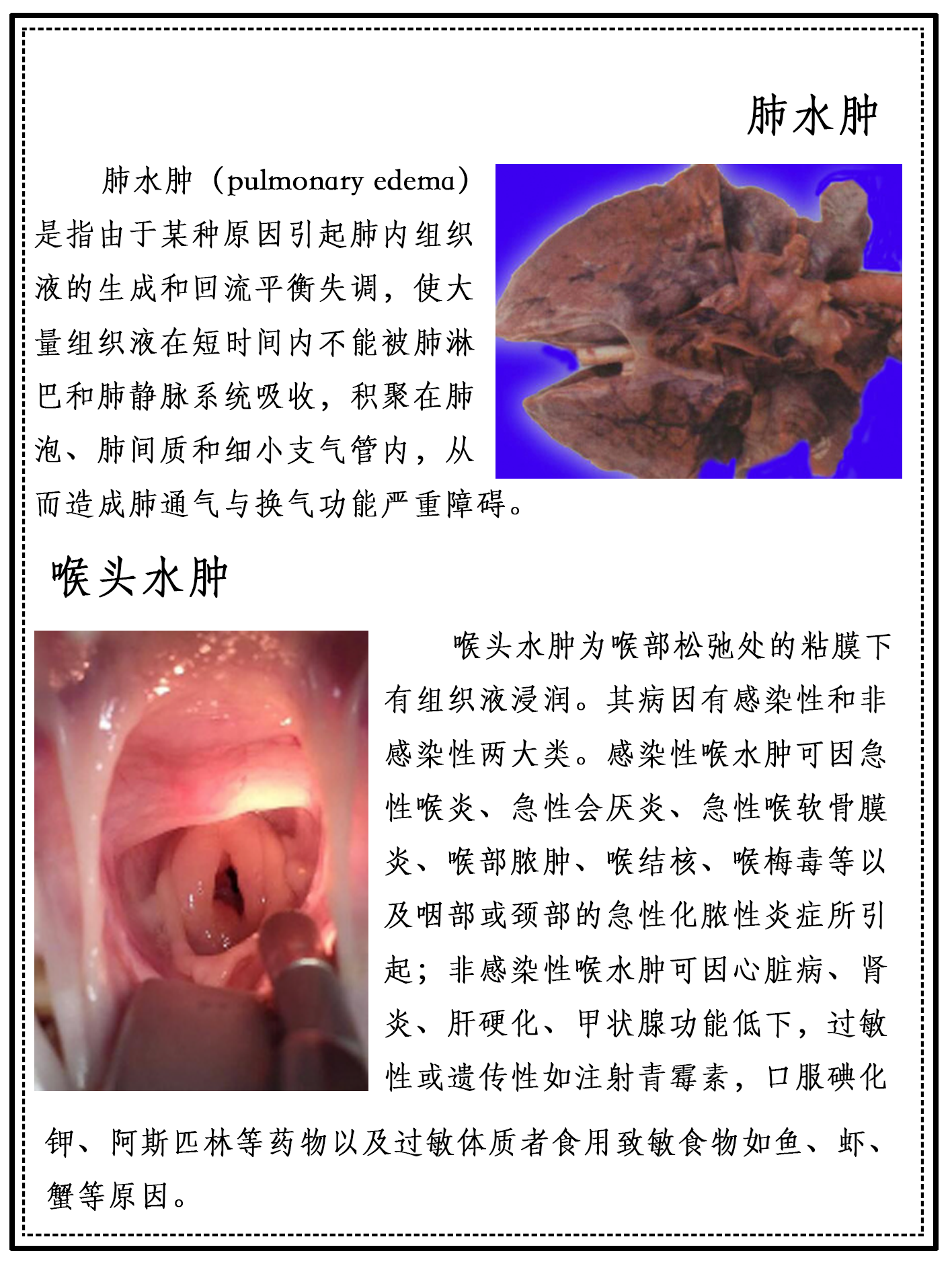 肺水肿,喉头水肿