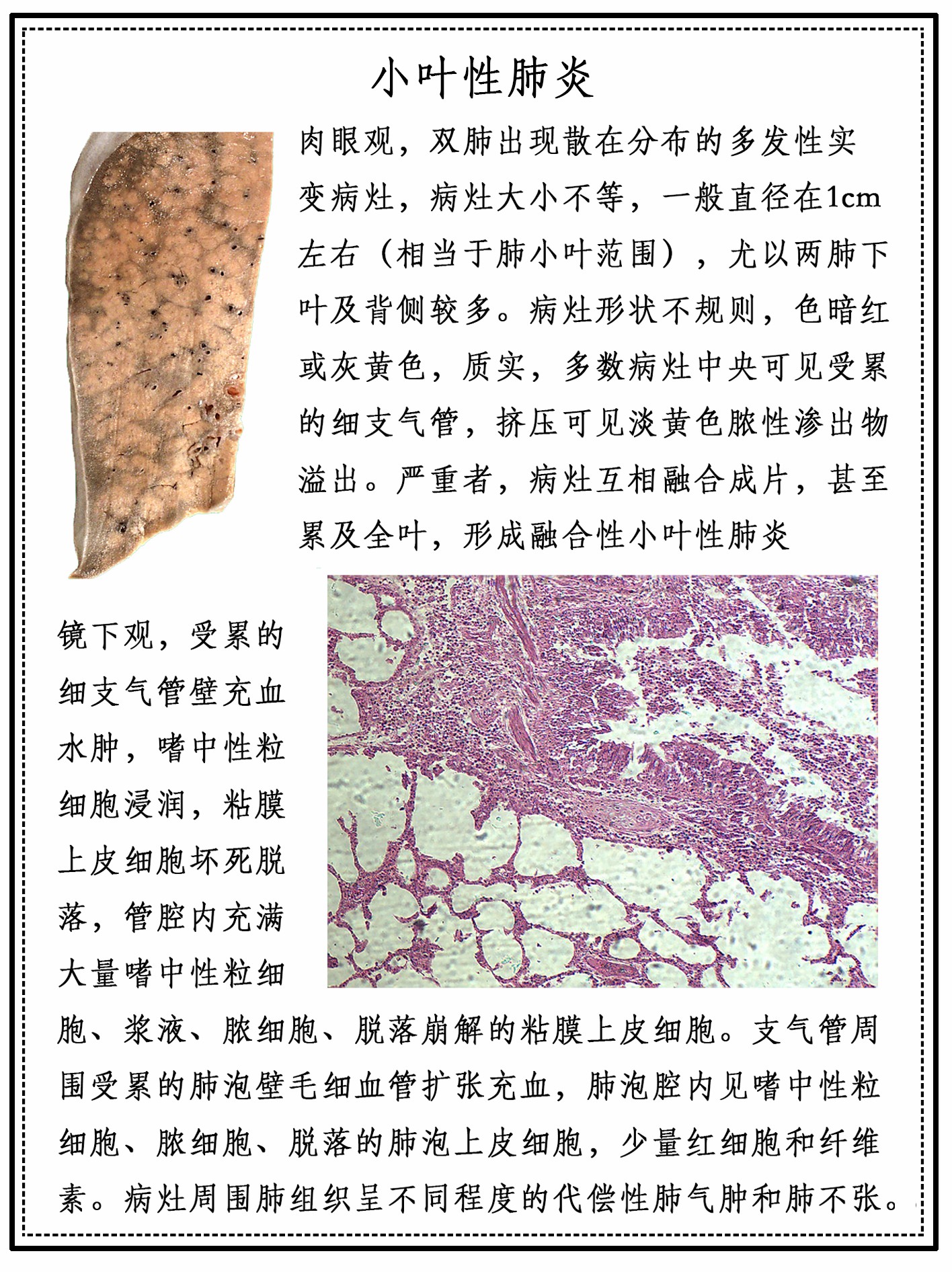 小叶性肺炎