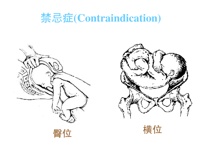 缩宫素的作用及禁忌症2.png