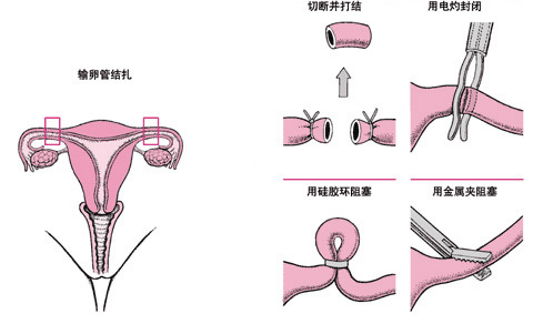 输卵管绝育术