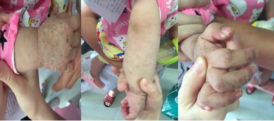 出院当天Cox A6手足口病患者皮疹1.png