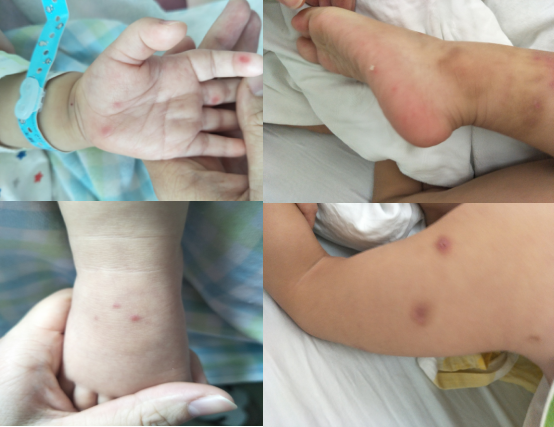 EV 71手足口病患者皮疹.png