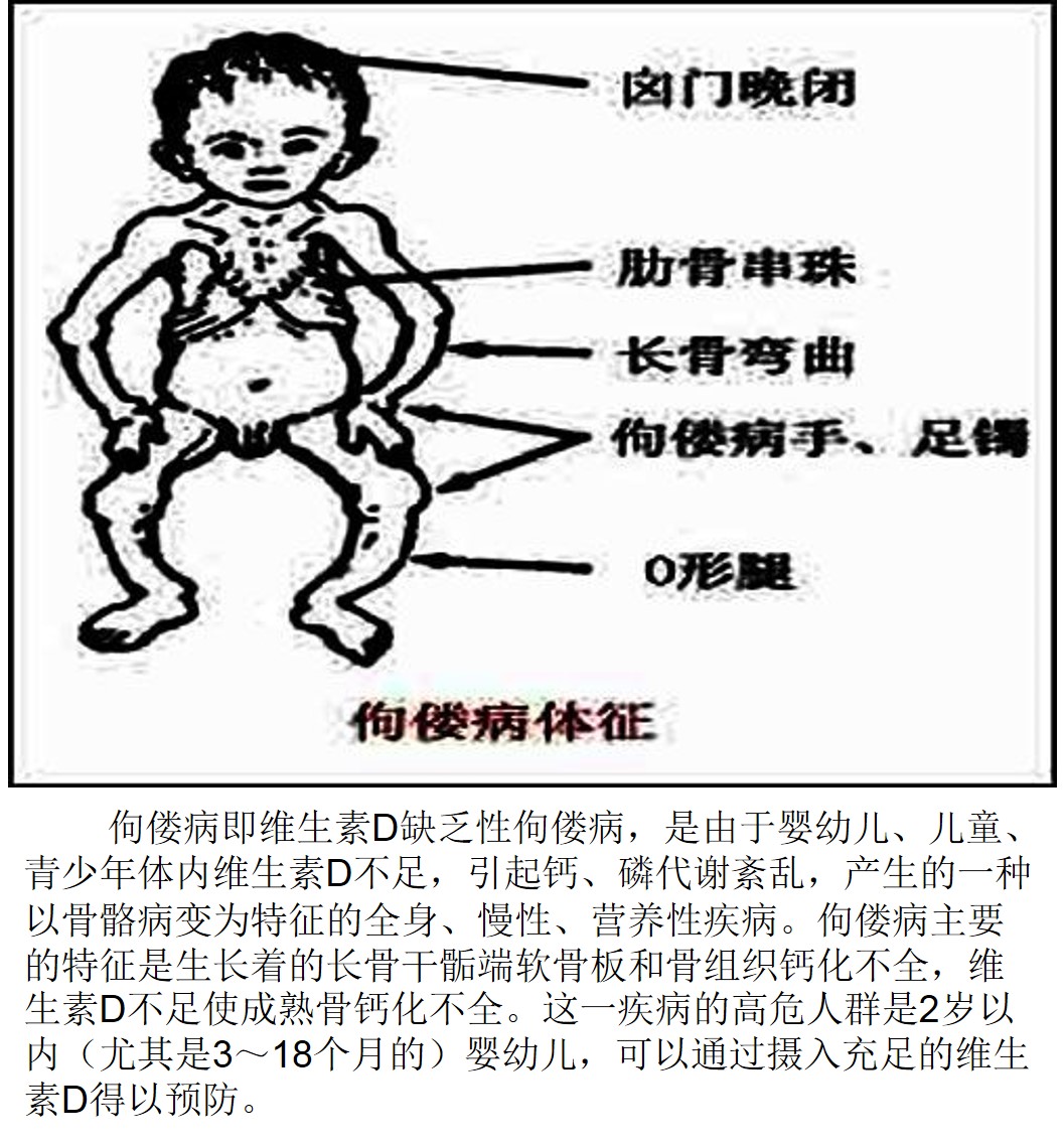 【述评】中国儿童维生素D缺乏性佝偻病诊治变迁_诊断_标准_全国