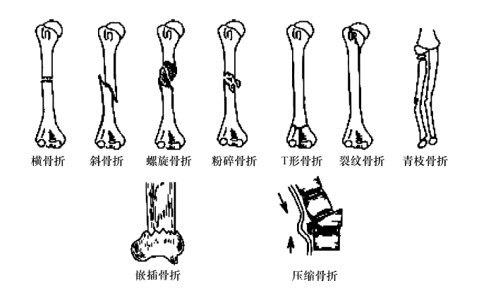 ①裂纹骨折:骨折像瓷器上的裂纹,无移位,多见于颅骨,髂骨等处的骨折.