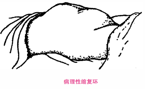 (2)不协调性宫缩过强: ①强直性子宫收缩:子宫内口以上肌纤维普遍性