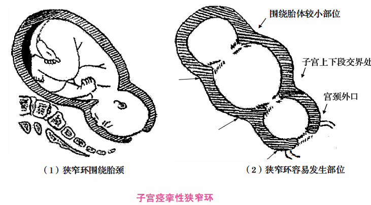 ②子宫痉挛性狭窄环:子宫局部肌肉强直性收缩,形成环状狭窄,缠绕胎体