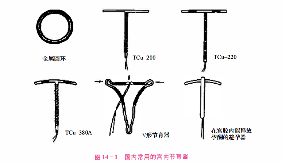 宫内节育器