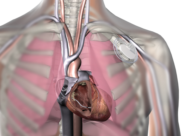 人工心脏起搏器