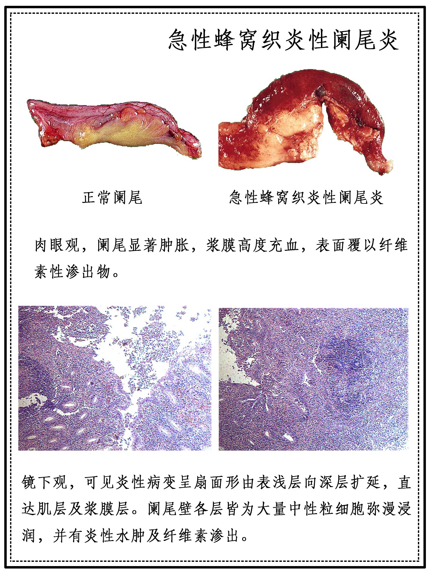 蜂窝织性阑尾炎图片