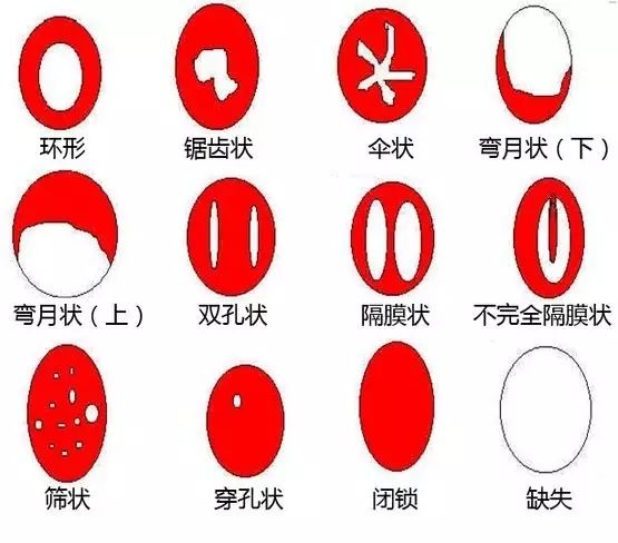 处女膜形态.jpg