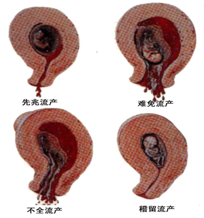 妇科检查:子宫大小与停经周数相符,宫颈口未开,胎膜未破,妊娠产物未