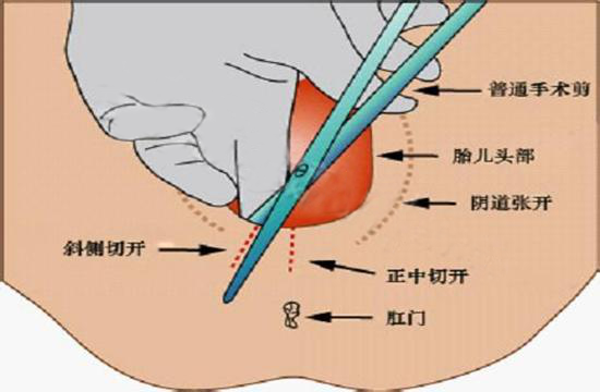 宫颈锥切手术过程图图片