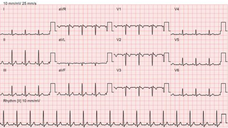 正常12导联心电图特点: p波方向在i,Ⅱ,avf,v 4～v 6导联向上,avr导联