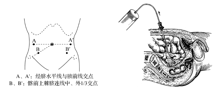 诊断性腹腔穿刺与灌洗