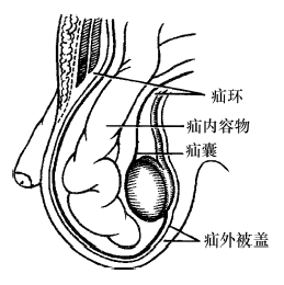腹外疝的组成及分类