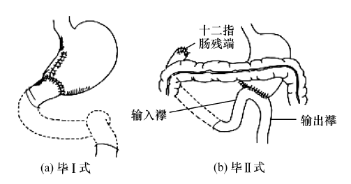 毕氏Ⅰ式是在胃大部切除后,将残胃直接与十二指肠吻合,其优点是手术