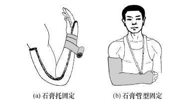 ② 石膏绷带固定:石膏绷带是将脱水硫酸钙(熟石膏)细粉末撒布于特制的