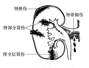 肾损伤的发病机制
