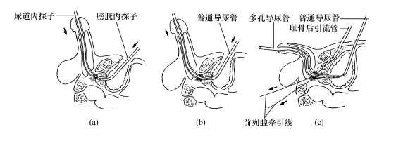 尿道会师复位术