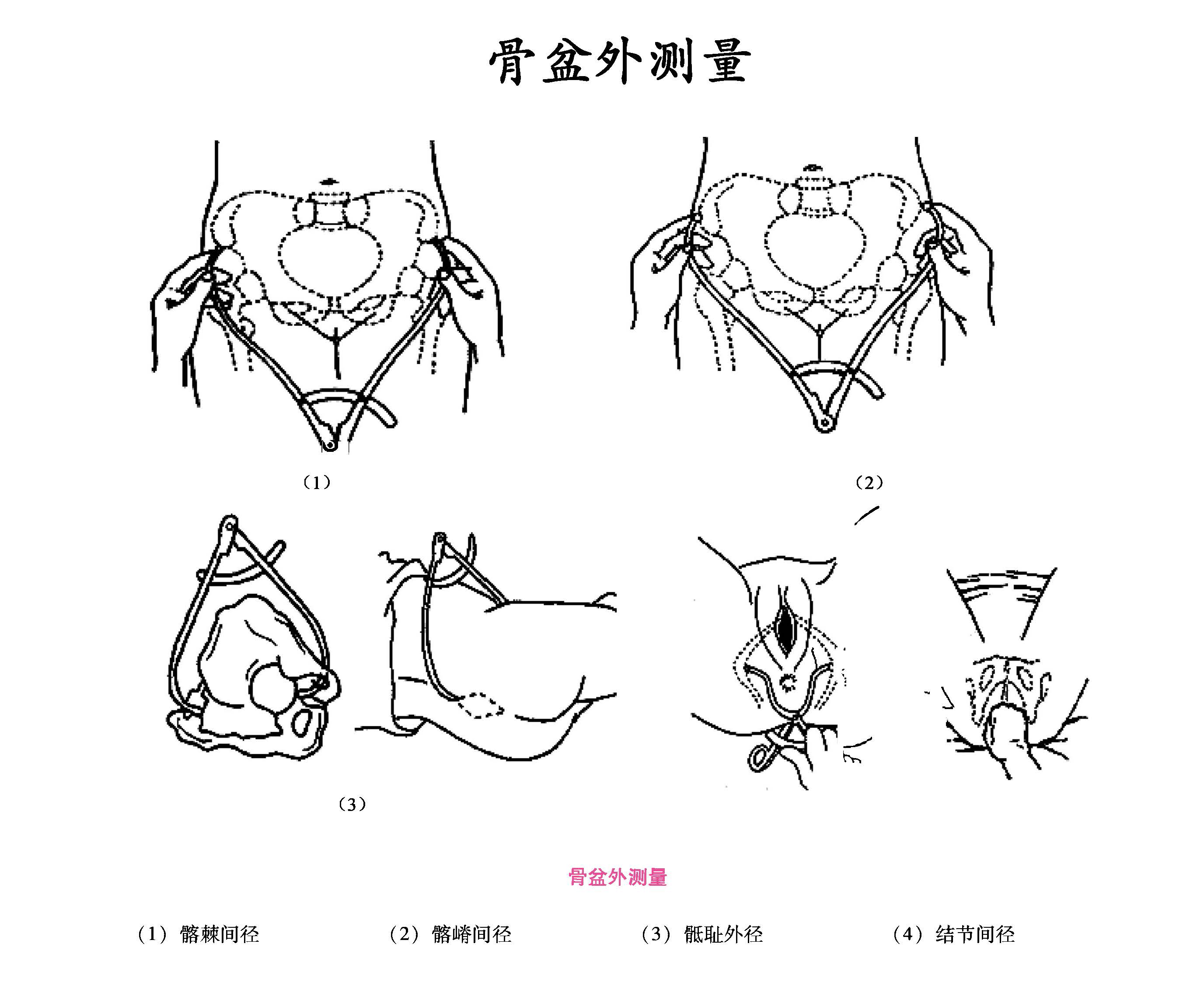 骨盆外测量示意图图片