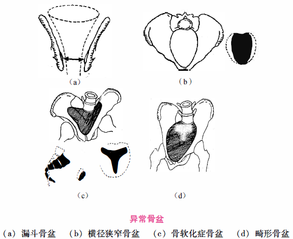 (2)中骨盆及出口平面狭窄:漏斗骨盆(男性型骨盆)和横径狭窄骨盆(类