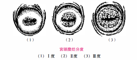 (2)宫颈肥大:由于慢性炎症的长期刺激,宫颈组织充血,水肿,腺体和间质