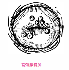 局部充血,水肿,有时宫颈管黏膜增生,向外口突出,即可见宫颈口充血发红