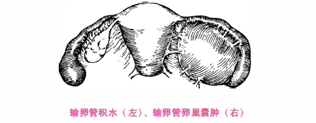 (2) 慢性输卵管炎与输卵管积水:多为双侧性,输卵管呈轻度或中度肿大