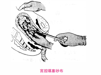 宫腔填塞纱布