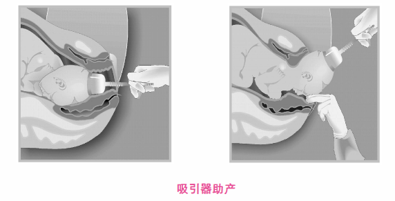 胎头吸引术