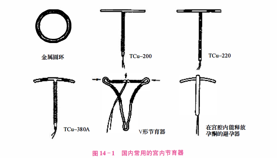 t型节育环结构图片
