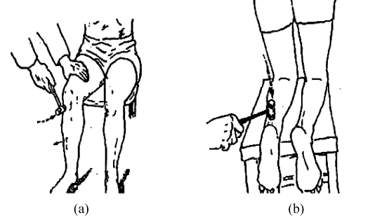 人体腱反射检查